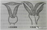 处女膜位置解析：女性生理的小秘密