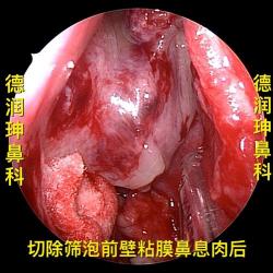 揭秘鼻子出血的幕后原因：肝火、鼻窦炎还是鼻息肉？