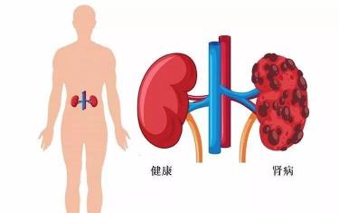 患上尿毒症多半是因常做这些事：了解背后的隐患，保护肾脏健康！