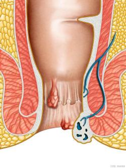 肛门长肉团：原因与应对策略