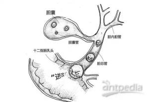 胆结石是怎么形成的？原因分析与预防策略