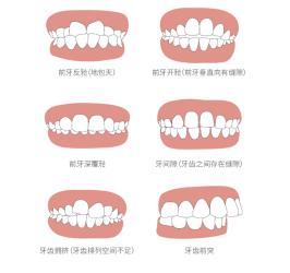 前牙反合揭秘：如何认识与应对这种常见牙齿问题