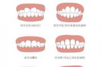 前牙反合揭秘：如何认识与应对这种常见牙齿问题