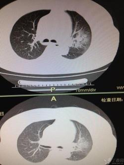 痰中带血是怎么回事？了解潜在原因及治疗方法