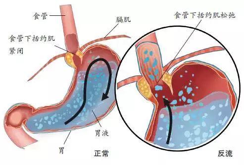 食管炎治疗良药：这些药物你需要知道！