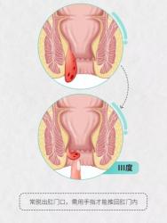 脱肛的症状：了解与识别，守护您的健康