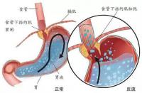 食管炎治疗良药：这些药物你需要知道！