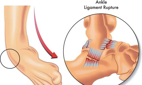 脚扭了怎么办？全方位应急处理与恢复指南