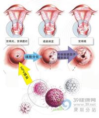 宫颈糜烂：生理与病理之间的差异及应对措施