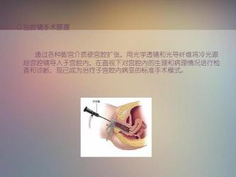 宫腔镜手术多长时间？快速了解子宫疾病治疗新选择