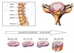 腰椎间盘突出怎么办？保守治疗还是手术治疗？