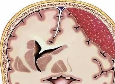 硬膜下血肿：了解症状，把握治疗关键