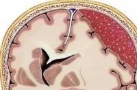 硬膜下血肿：了解症状，把握治疗关键