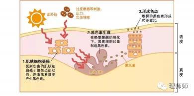 皮肤色斑成因解析：从遗传到生活习惯全方位了解