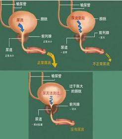 什么叫前列腺？一文带你了解男性健康的重要腺体