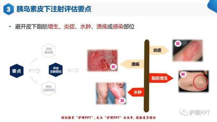 皮下注射：胰岛素、肾上腺素与儿童疫苗的应用与注意事项