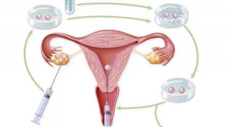 人工授精：解决不孕不育难题，实现生育梦想新途径