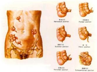 左侧腹股沟疼痛的原因与治疗方法：从阑尾炎到腹股沟疝的全面解析