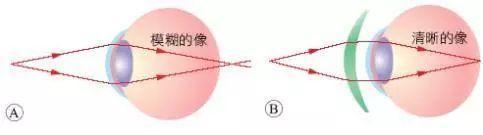 远视眼揭秘：视物模糊背后的真相