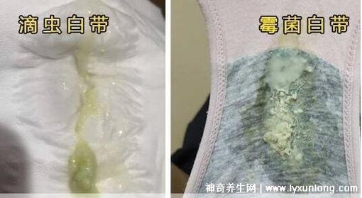 白带有血丝或呈褐色的原因解析：生理与疾病的双重考量