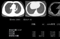 CT辐射量：了解CT检查中的辐射及其影响