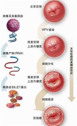 HPV52高危感染：如何预防与应对