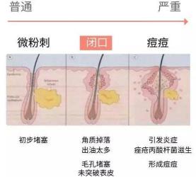 粉刺是什么？揭秘皮肤小问题的真相