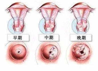 子宫颈炎治疗全攻略：药物治疗、物理治疗还是手术治疗？