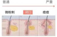 粉刺是什么？揭秘皮肤小问题的真相