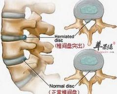 腰间盘突出症状大解析：从疼痛到活动障碍的全面了解