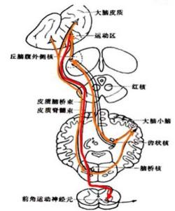 脑出血后遗症：了解症状，守护健康——一文带您认识脑出血后的常见并发症