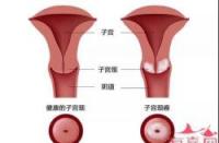 子宫囊肿是怎么形成的？成因与预防全解析，守护女性健康新指南