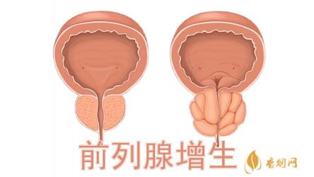 前列腺增生手术：了解症状与选择最佳治疗方式