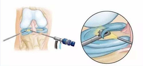 半月板损伤咋治疗？专家解析治疗与护理新策略，助你快速康复！