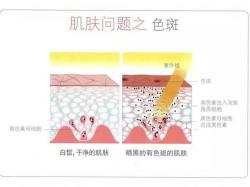 雀斑的形成原因揭秘：从紫外线到不良生活习惯全面解析