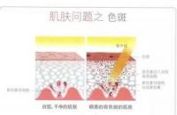 雀斑的形成原因揭秘：从紫外线到不良生活习惯全面解析