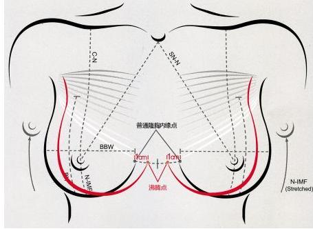 乳房下垂整形秘籍：如何科学有效地重塑挺拔美胸