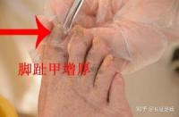 揭秘脚趾甲变厚：原因与治疗全解析