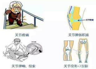 膝关节滑膜炎：原因、症状与治疗全解析