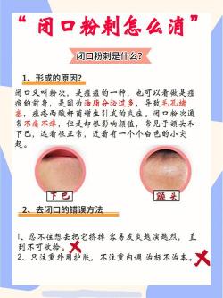 粉刺与痘痘：区别、成因及应对方法