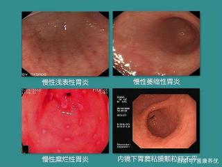 重度胃萎缩的治疗方法：从消除病因到保护胃黏膜的综合方案