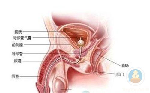 治疗前列腺增生的多种方法：从饮食到手术的全面解析