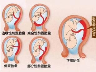 前置胎盘：孕期的重要关注点与应对方法