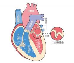 二尖瓣轻度狭窄：了解症状、诊断与治疗的重要性