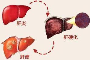 丙肝病毒携带者：症状、饮食与生活建议