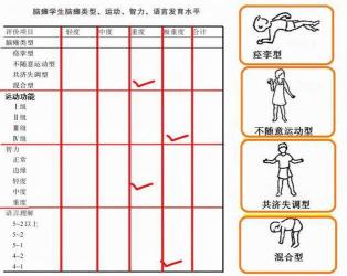 脑瘫早期症状识别：警惕发育迟缓与行动异常