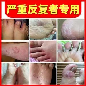 脚气烂脚趾缝痒溃烂怎么治：外用药、内服药及生活习惯改善三管齐下