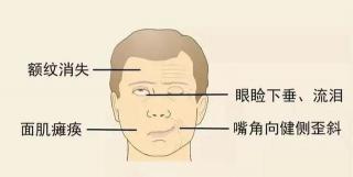 面瘫怎么办：轻度、急性期与恢复期的治疗方法一览