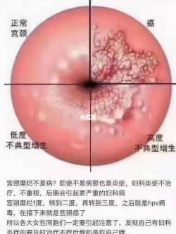 下体塞了东西能自己排出来吗？原因与应对方法详解