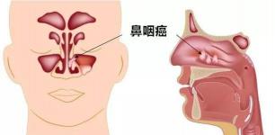 鼻癌症的早期症状：警惕这些隐秘的警示信号